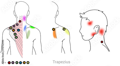 Trapezius: Myofascial trigger points and associated pain locations