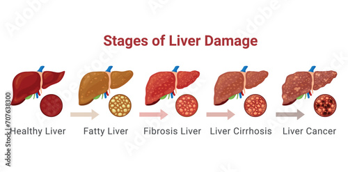 Stages of liver damage infographic medical scheme with arrows vector flat illustration
