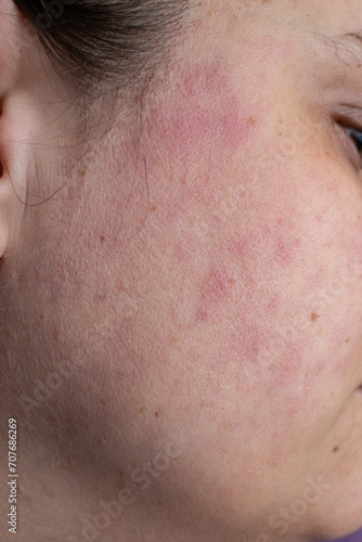 Red rash eczema on a woman face due to live disease , close up texture