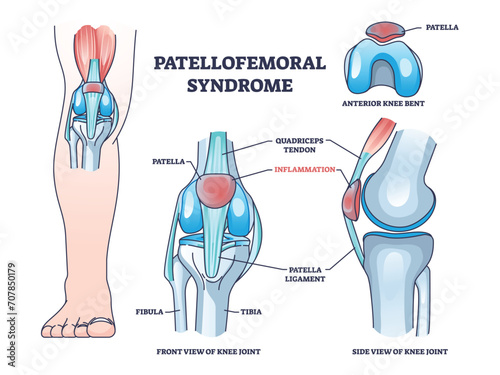 Patellofemoral pain syndrome as anatomical knee condition outline diagram. Labeled educational scheme with leg kneecap patella part inflammation vector illustration. Joint quadriceps tendon location