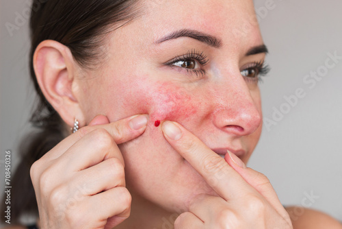 A young Caucasian brunette woman squeezes a pimple on her cheek until it bleeds, with tears in her eyes from the pain. Dermatology, acne, rosacea, problematic facial skin