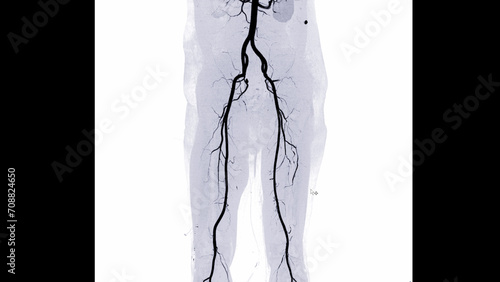 CTA femoral artery run off image of femoral artery for diagnostic Acute or Chronic Peripheral Arterial Disease.