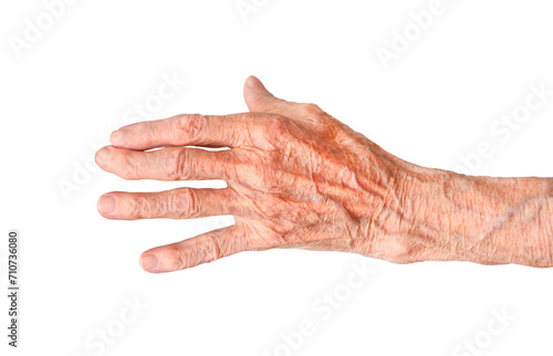 Rheumatoid polyarthritis of the hand of a 95 year old woman isolated on a white background.