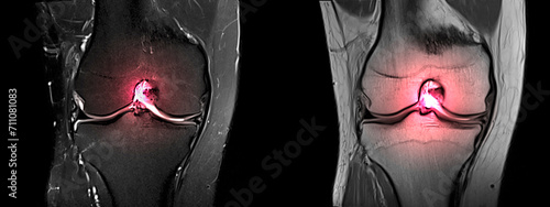 Magnetic resonance imaging or MRI of knee.Closed injury of the knee joint, with manifestations of arthrosis.Knee pain in sport injury.Orthopedic surgeon plan cruciate ligament reconstruction surgery.