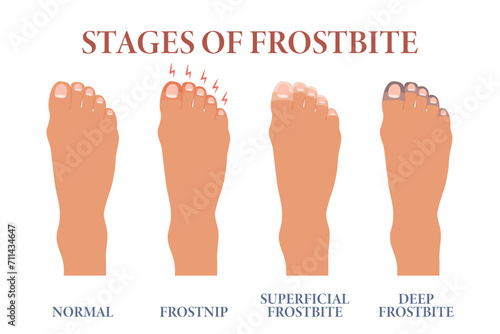 Frozen toes. Stages of frostbite of fingers. Healthcare and medicine. Vector