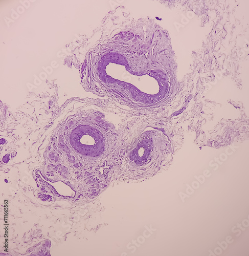 Prostatic Tissue (biopsy): Sections show show fatty tissue, neural tissue and muscle tissue. Prostate cancer diagnosis.