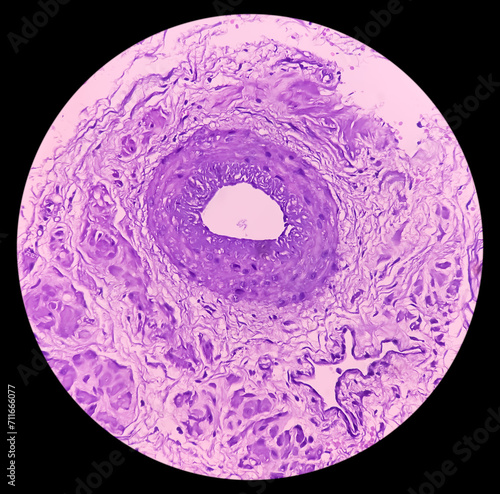 Prostatic Tissue (biopsy): Sections show show fatty tissue, neural tissue and muscle tissue. Prostate cancer diagnosis.