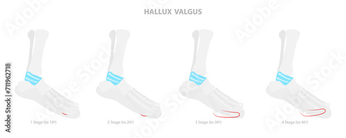 3D Isometric Flat Conceptual Illustration of Hallux Valgus, Bunion in Foot
