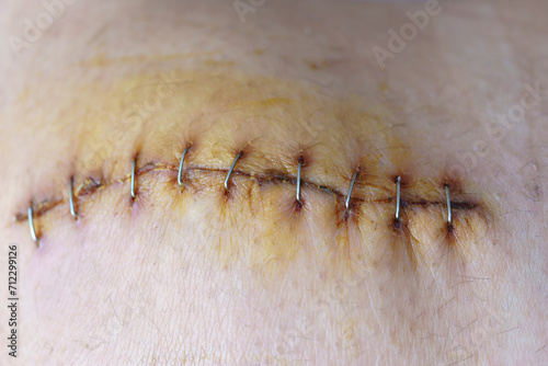 The surgical wound around the knee was sutured with staples.