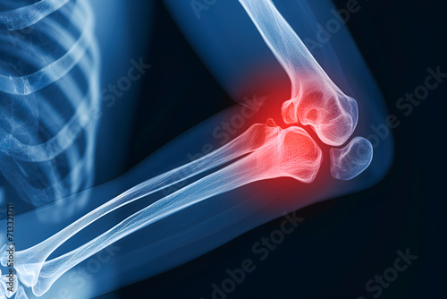 3d Illustration Of Broken Human Elbow Injury, Medical Concept. Pain In The Elbow