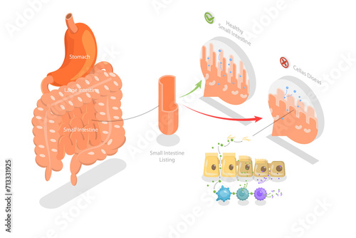 3D Isometric Flat Conceptual Illustration of Celiac Disease, Educational Diagram