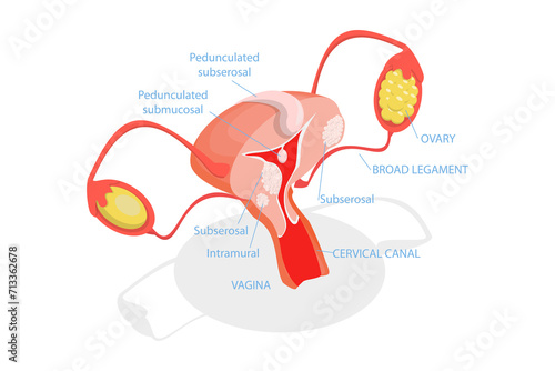 3D Isometric Flat Conceptual Illustration of Types Of Uterine Fibroids, Human Anatomy