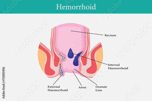 Cross section of the rectum and anal canal. illustration of hemorrhoids structure
