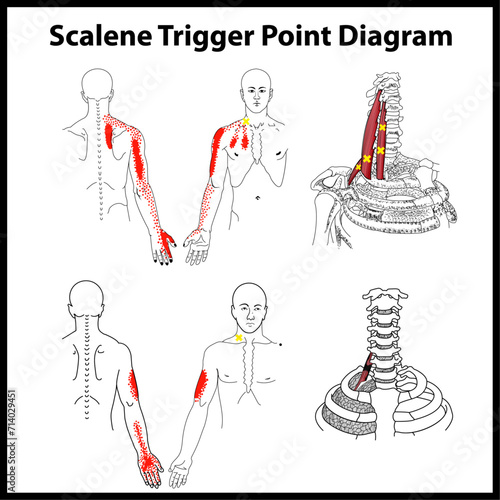 Scalene Trigger Point vector Diagram