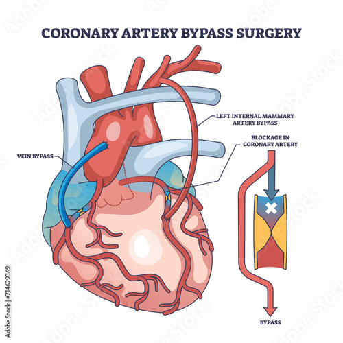 Coronary artery bypass surgery for blocked blood flow outline diagram, transparent background. Labeled educational scheme with heart procedure and cardiology condition illustration.