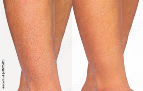 Image compare woman legs with hairs and hairless. Result before and after leg hairs removal, skin care and beauty concept.