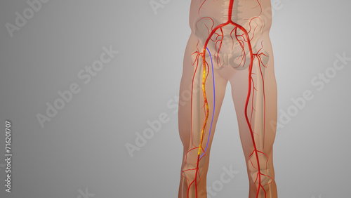 Peripheral artery bypass surgery medical animation