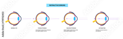 Refractive errors poster