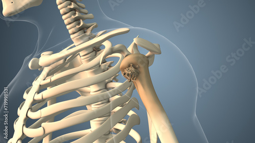 Cancer spreading along shoulder bone