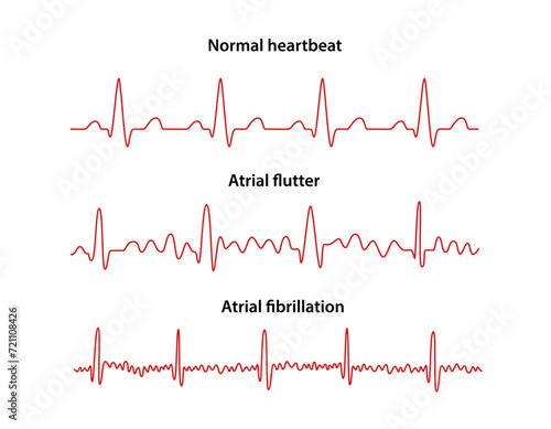 Diagram of normal rhythm, Atrial flutter and Atrial fibrillation for a human heart. Heart cardiogram. Vector illustration in flat style isolated on white background