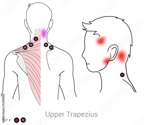 Upper Trapezius: Myofascial trigger points and associated pain locations