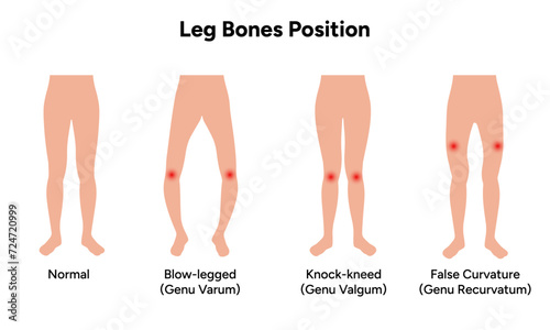 Leg bones position Blowlegged knock kneed face curvature