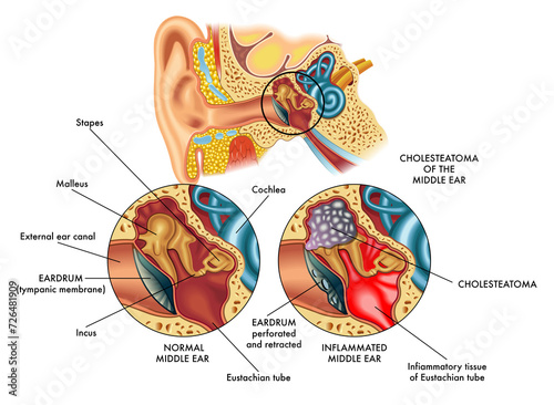 Medical illustration comparing the internal part of the ear (middle ear) on the left healthy and on the right affected by cholesteatoma, with annotations.