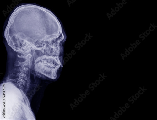 X-ray image of lateral head and cervical spine. Black background.