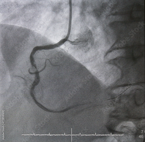 Coronary angiogram (CAG) was performed total occlusion at right coronary artery (RCA).