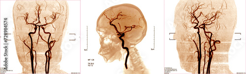 blood vessels x-ray images in the brain for diagnose cerebrovascular disease or hemorrhagic stroke.