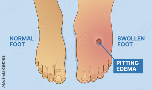 Normal foot, swollen foot. Before, after. Pitting edema. Vector illustration. 