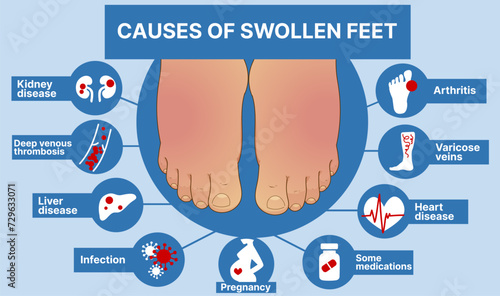 Causes of swollen feet. Healthcare infographic, educational illustration. Vector illustration. 