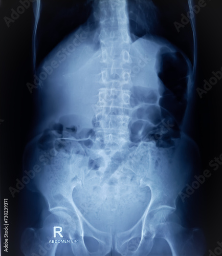Plain X-ray of Abdomen in erect posture. Large bowel loops are distended with gas and loaded faecal matters.