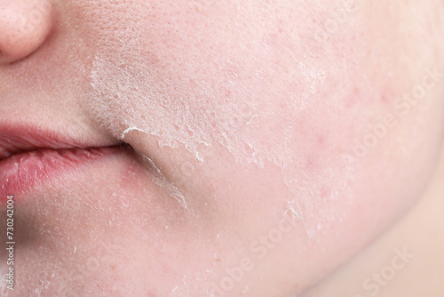 Woman with dry skin on face, closeup