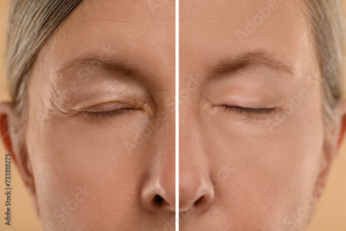 Aging skin changes. Woman showing face before and after rejuvenation, closeup. Collage comparing skin condition