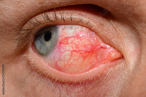 Bardzo przekrwione oko z widocznymi naczynkami krwionośnymi 