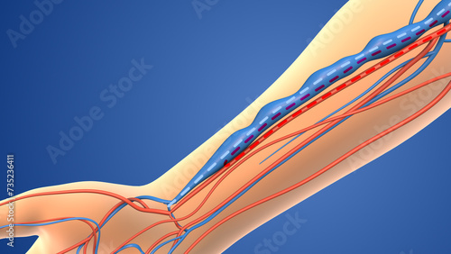 Medical animation of the Arteriovenous fistula