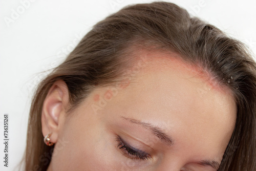 Inflammation of the scalp in a young woman. Problems with dandruff, seborrhea, itching, redness, dryness, lichen, fungal infection. Skin disease, dermatitis. Red round spots on the head and forehead