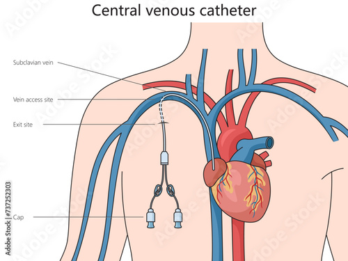 Central venous catheter structure diagram hand drawn schematic vector illustration. Medical science educational illustration