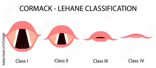 The Cormack–Lehane (CL) classification system classifies views obtained by direct laryngoscopy based on the structures seen. Medical procedure vector illustration isolated on white background.