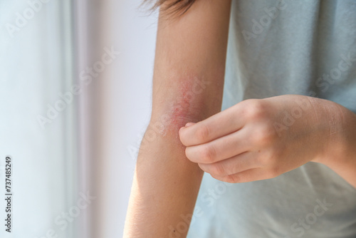 a girl scratches the skin on the elbow of her arm, redness is atopic dermatitis, the girl s face is not visible