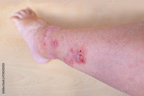 allergic reactions, itchy skin on leg, hives and other skin manifestations, Foot and Leg Conditions, skin problems on general physical and emotional well-being