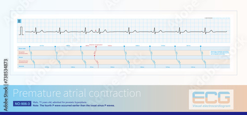 The ECG diagnosis of atrial premature contraction is an early P wave with a morphology that differs from sinus P wave and is mostly incomplete in compensatory intervals.