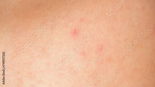 Problem skin with acne. close-up of a body part.