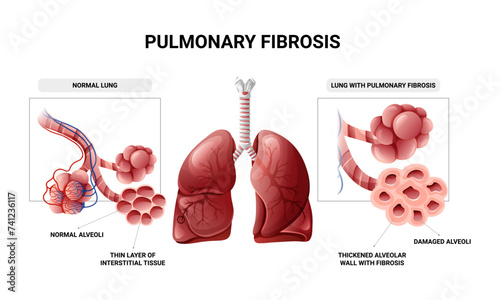Pulmonary fibrosis and normal lung tissue infographic. Vector illustration isolated on white background