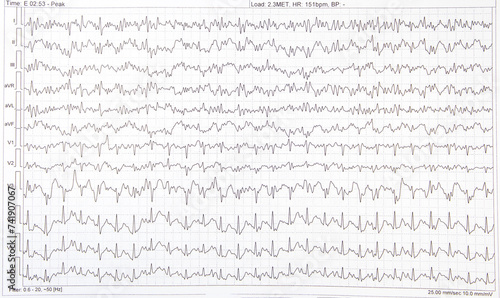 ECG electrocardiogram of a heart disease person