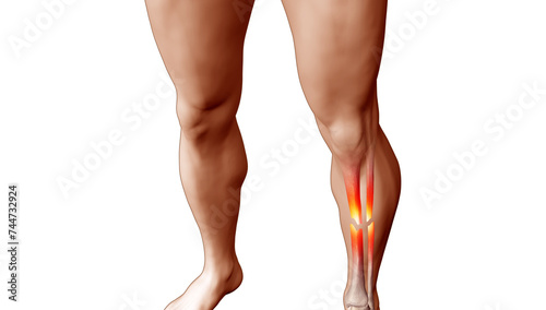 Medical Illustration of Broken Tibia and Fibula on Athletic Male Body