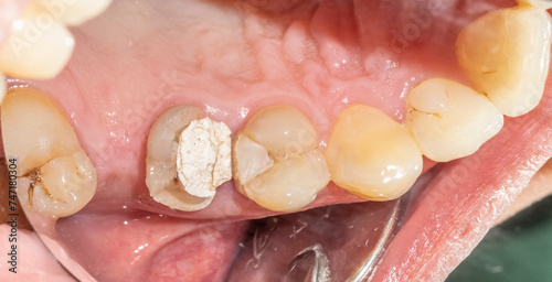 Decayed premolar crown destroyed. Filled with a self-curing zinc-oxide eugenol-based temporary cement and a composite resin restoration. Directly below view, lip retracted with dental mirror.