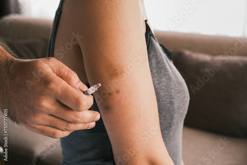 Closeup of giving an intramuscular anticoagulant injection into the arm using a safety syringe. Blood thinning medication or insulin injection. Bruising on the arm caused by previous injections