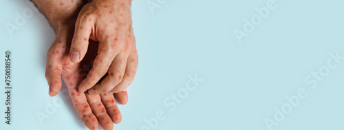 Human Hands with Painful Rash, Red Spots Blisters on the Skin. Health Problem. Monkeypox Disease Symptoms. Male Patient Arms with Monkey Pox. Close Up. Banner, Copy Space. Dengue Fever Infection, MPOX